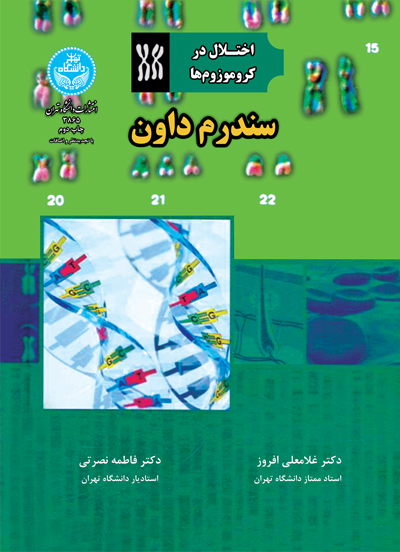 پایانه - سندروم داون